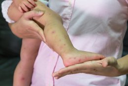 Šiandienos aktualijos: augantis tymų pavojus, globą paliekantys vaikai ir 15 metų Europos Sąjungoje