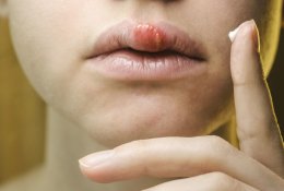 Gydytoja perspėja: apie 80 proc. užsikrėtusių paprastąja pūsleline nejaučia jokių simptomų, nors daliai gresia pavojus