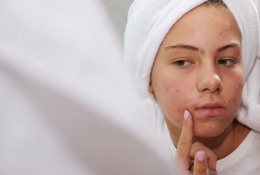 Kovoje su akne: kosmetologės patarimai, padėsiantys pagerinti odos būklę