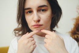 Vasarą padažnėja aknė – kaip jos išvengti?