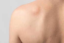 Kas lemia lipomos – dažniausio minkštųjų audinių auglio – atsiradimą?