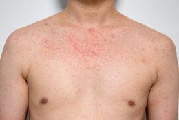 Sulauksime tymų protrūkio? Gydytoja įspėja apie grėsmę