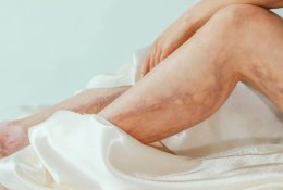 Melsvi kapiliarų „voratinkliai” ant kojų – ką jie reiškia ir kada kreiptis į gydytoją?