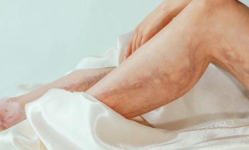 Melsvi kapiliarų „voratinkliai” ant kojų – ką jie reiškia ir kada kreiptis į gydytoją?
