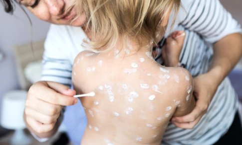 Šeimos gydytoja: vėjaraupiai gali sukelti sunkias komplikacijas