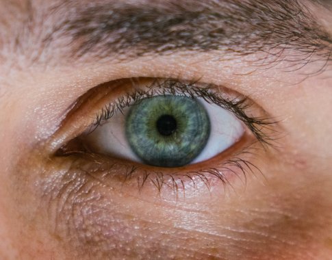 Gyvenimą apsunkinantys užkritę akių vokai: gali sukelti galvos skausmus ar uždegimą