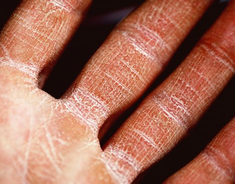 Sausa ir sudirgusi oda? 5 patarimai, kaip išspręsti šią problemą Sausa ir sudirgusi oda? 5 patarimai, kaip išspręsti šią problemą