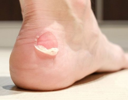 Kova prieš pūsles ant kojų – kaip jų išvengti ir pagreitinti gijimą? Kova prieš pūsles ant kojų – kaip jų išvengti ir pagreitinti gijimą?