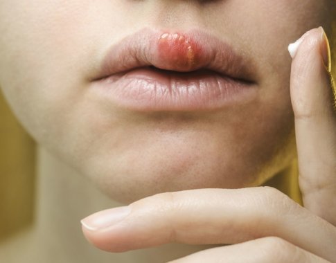 Gydytoja perspėja: apie 80 proc. užsikrėtusių paprastąja pūsleline nejaučia jokių simptomų, nors daliai gresia pavojus Gydytoja perspėja: apie 80 proc. užsikrėtusių paprastąja pūsleline nejaučia jokių simptomų, nors daliai gresia pavojus