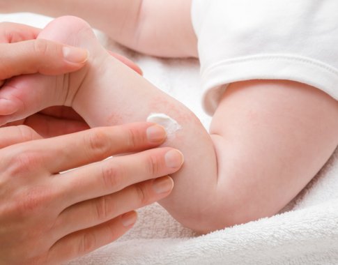 Kaip atpažinti kūdikių alergijas: tėvelių nuojauta pasiteisina ne visada