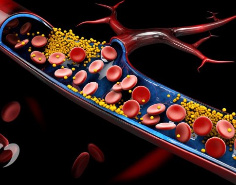 5 patarimai, kurie padės sumažinti padidėjusį cholesterolį