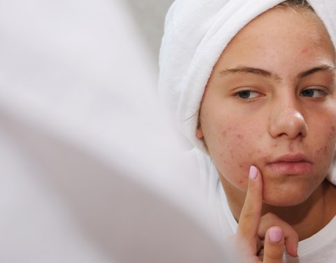 Kovoje su akne: kosmetologės patarimai, padėsiantys pagerinti odos būklę Kovoje su akne: kosmetologės patarimai, padėsiantys pagerinti odos būklę