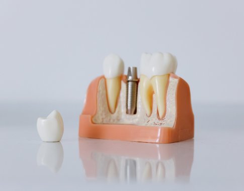 Naudingi patarimai, kaip prižiūrėti dantų implantus