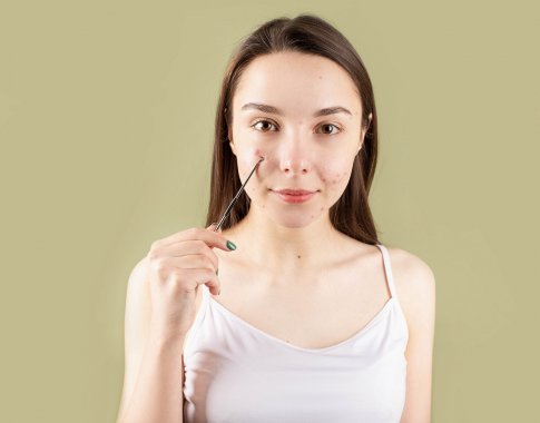 Mityba ir spuogai: kokią įtaką maistas daro odos būklei?