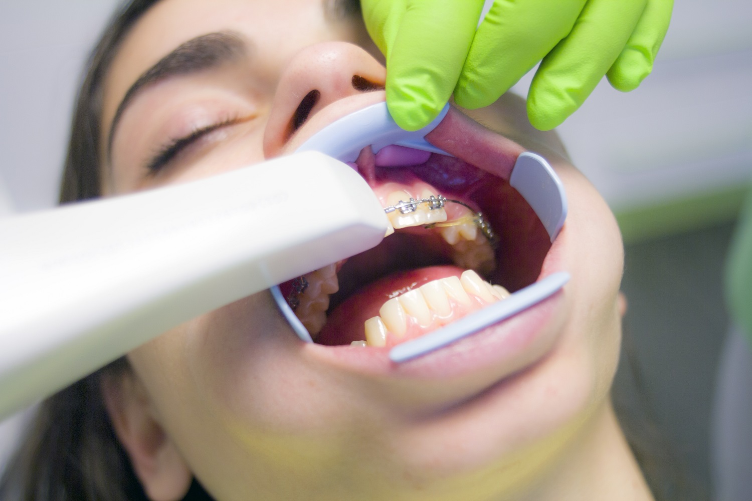 Gydytoja ortodontė: žmonės vengia breketų ir kapų dėl informacijos stygiaus
