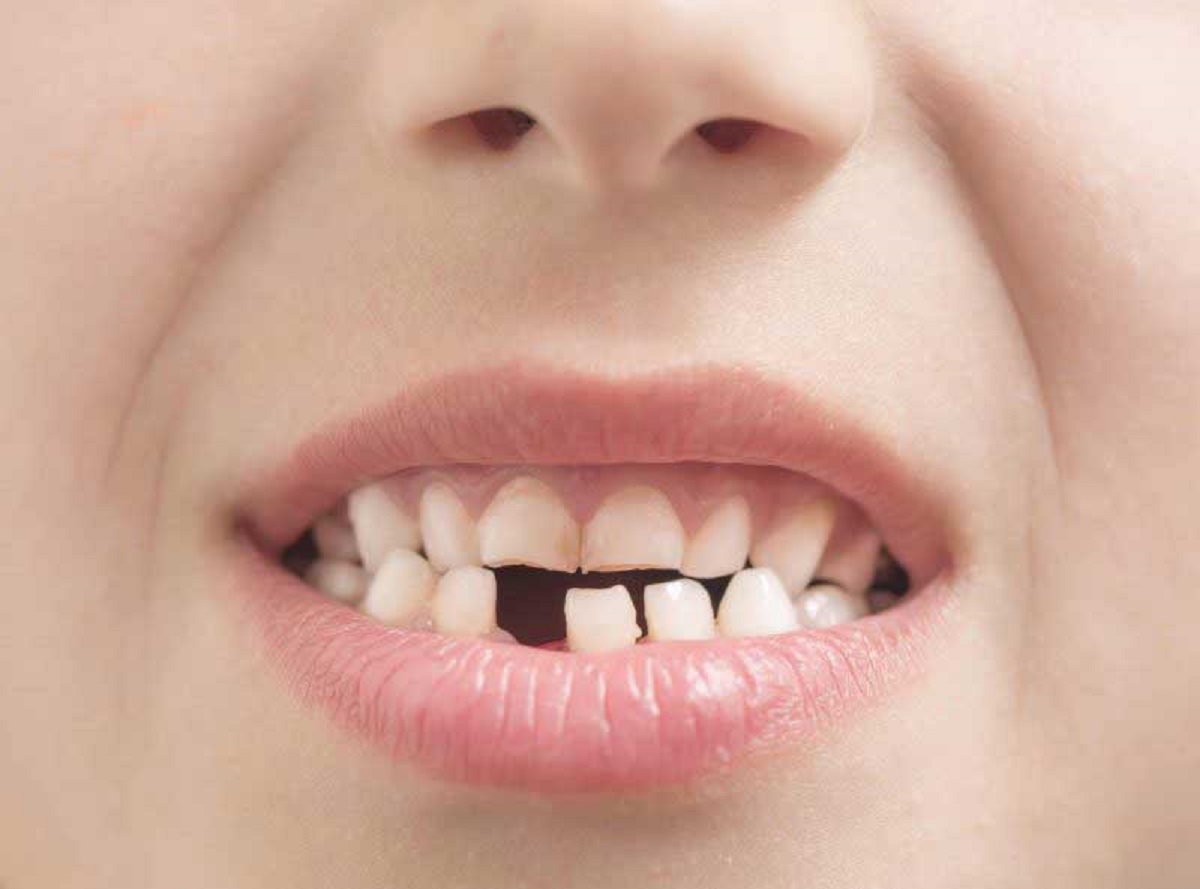 Odontologas pataria: kodėl svarbu ilgai nedelsti praradus dantį?