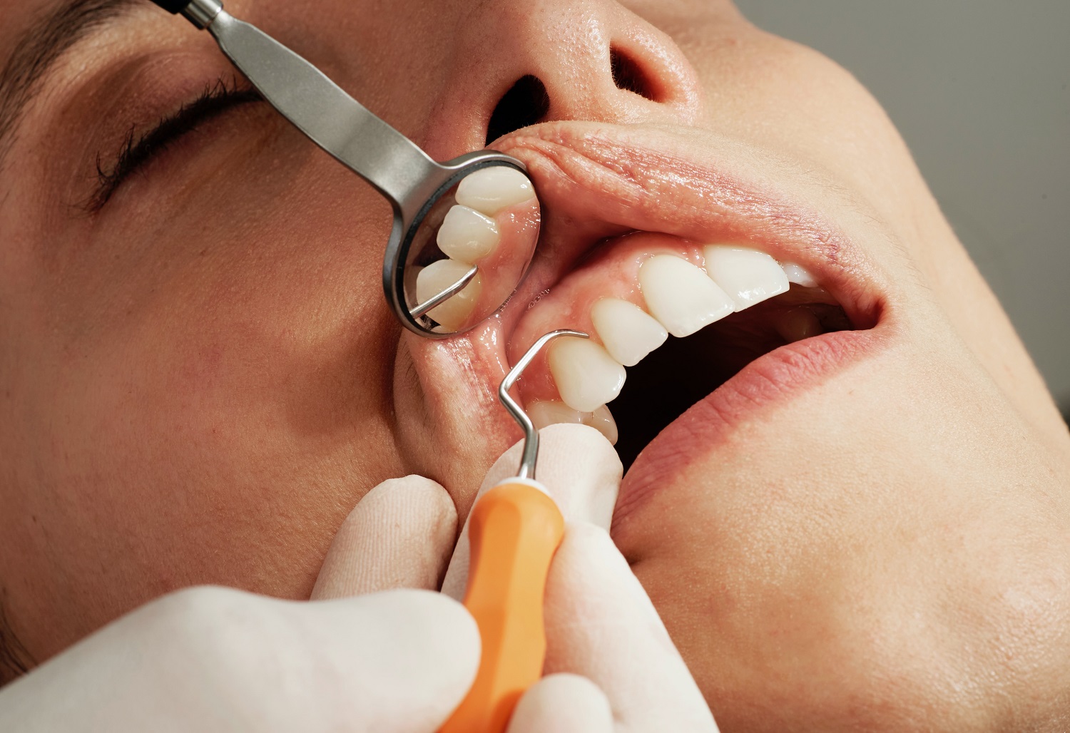 Kraujuojančios dantenos: negydant galima prarasti dantis