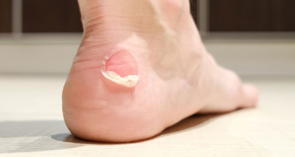 Kova prieš pūsles ant kojų – kaip jų išvengti ir pagreitinti gijimą?