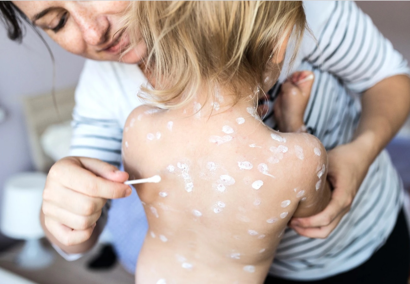 Šeimos gydytoja: vėjaraupiai gali sukelti sunkias komplikacijas Šeimos gydytoja: vėjaraupiai gali sukelti sunkias komplikacijas