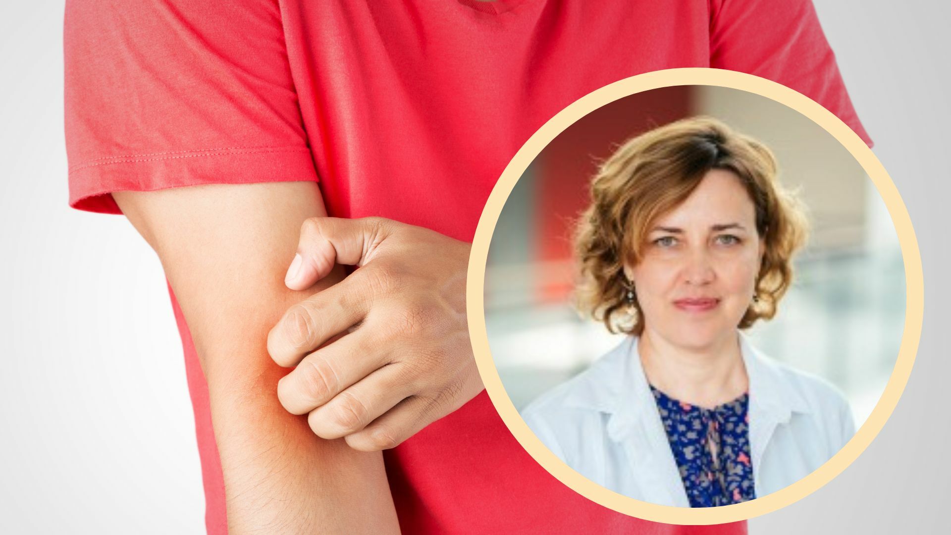 Dilgėlinė: kantrybę išbandanti ir gyvenimo kokybę bloginanti, bet dažniausiai praeinanti liga