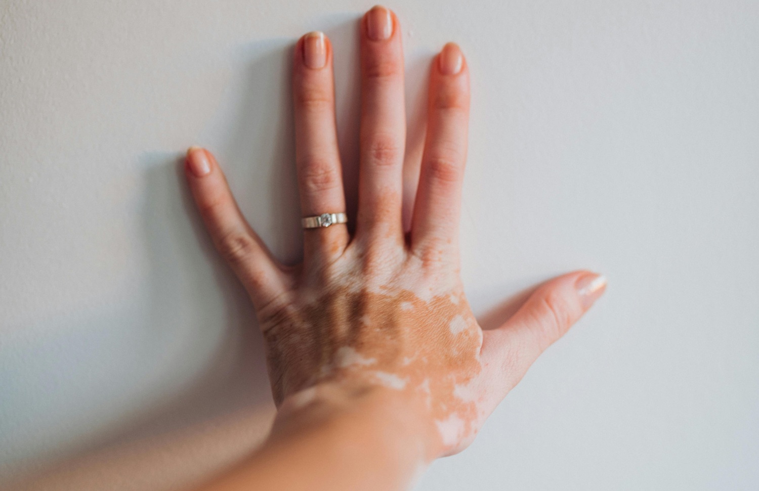 Pigmentinės dėmės: gydytojas pataria kaip jų išvengti ir išgyti jau atsiradusias